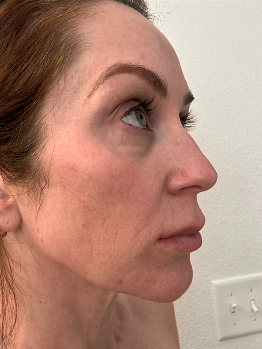 Before and After Red Light Therapy - A Nurse's Experience