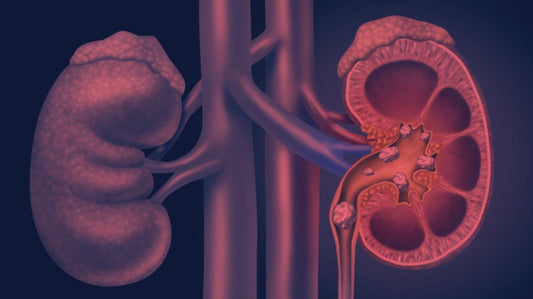 Can Red Light Therapy Help Kidney Stones?