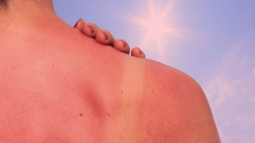 Red light therapy for sunburn