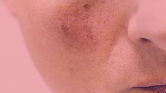 Does Red Light Therapy Help with Broken Capillaries