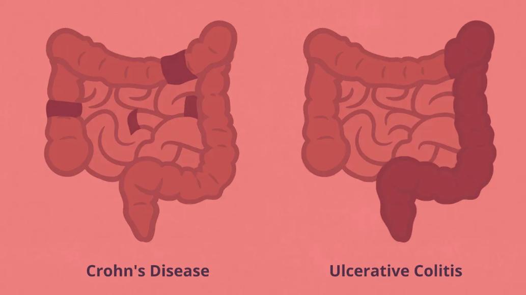 Red Light Therapy for Ulcerative Colitis