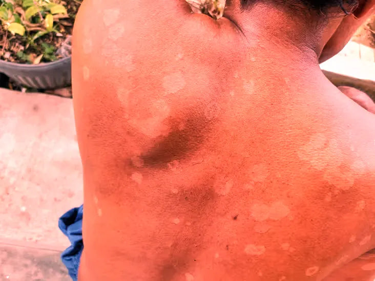 Red Light Therapy for Tinea Versicolor