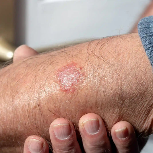 Can Red Light Therapy Provide Relief From Eczema?