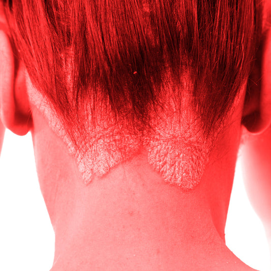 Red light therapy for Psoriasis