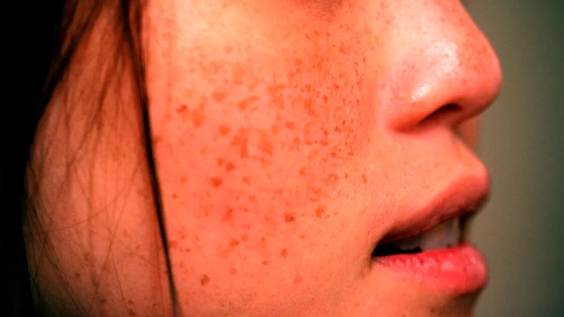 Red Light Therapy for Freckles